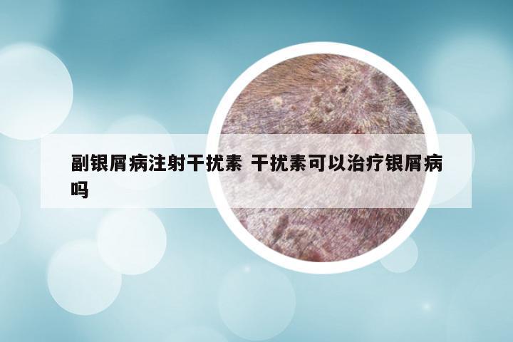 副银屑病注射干扰素 干扰素可以治疗银屑病吗