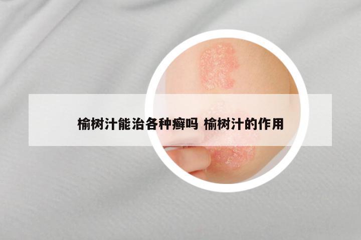 榆树汁能治各种癣吗 榆树汁的作用