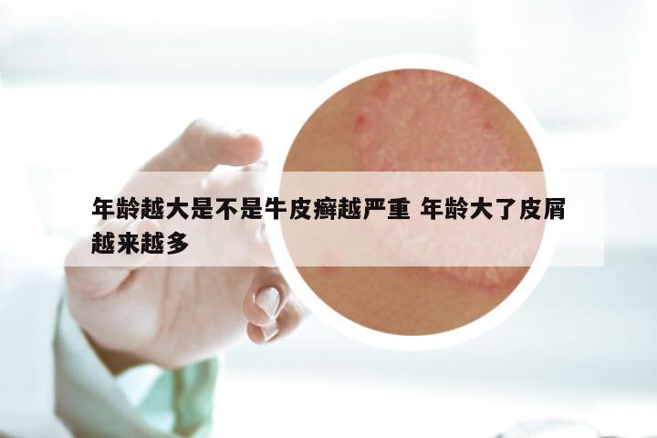 年龄越大是不是牛皮癣越严重 年龄大了皮屑越来越多