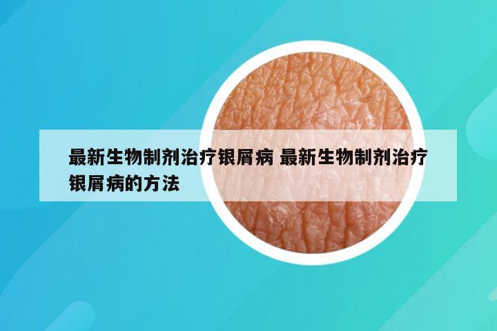 最新生物制剂治疗银屑病 最新生物制剂治疗银屑病的方法