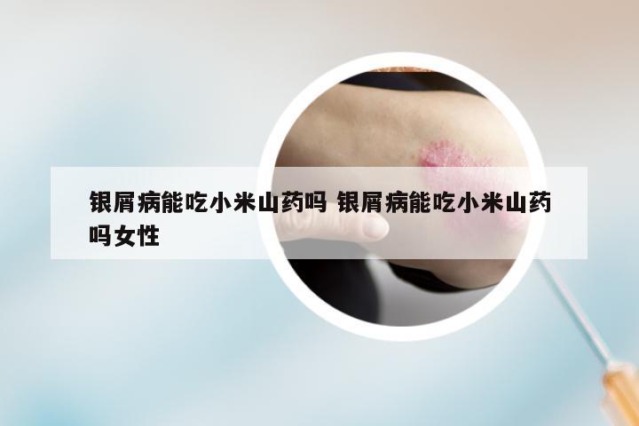 银屑病能吃小米山药吗 银屑病能吃小米山药吗女性