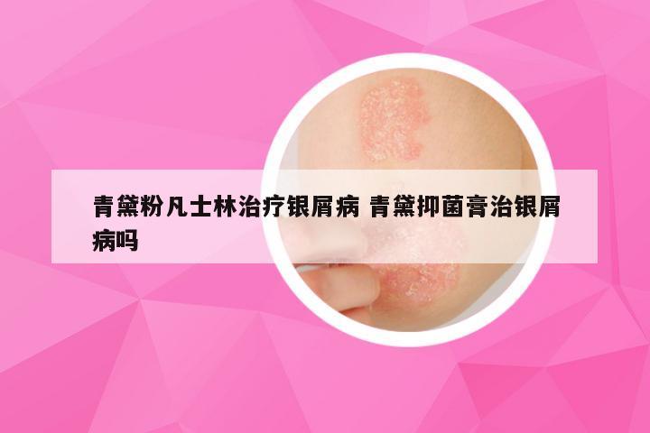 青黛粉凡士林治疗银屑病 青黛抑菌膏治银屑病吗