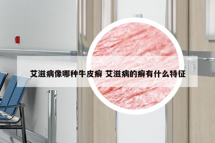 艾滋病像哪种牛皮癣 艾滋病的癣有什么特征