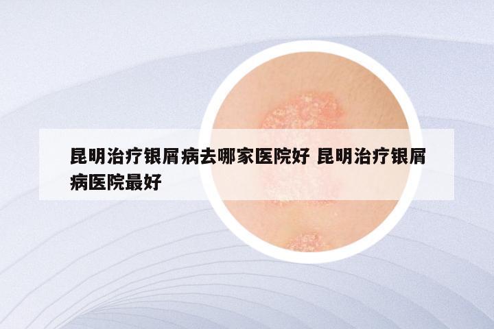 昆明治疗银屑病去哪家医院好 昆明治疗银屑病医院最好