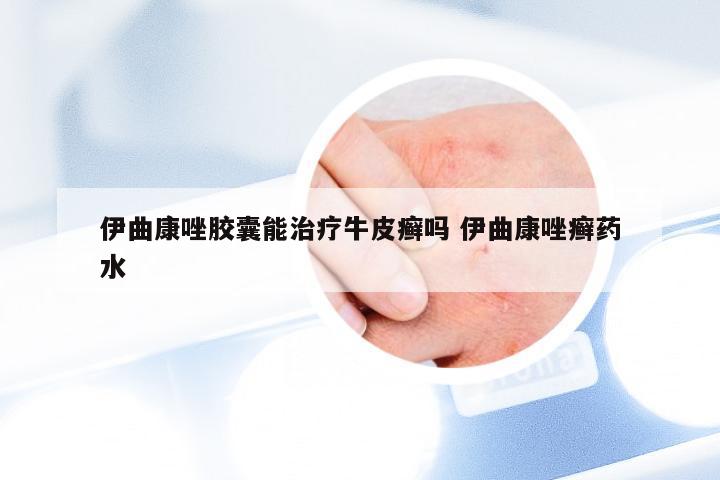 伊曲康唑胶囊能治疗牛皮癣吗 伊曲康唑癣药水