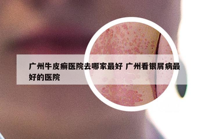 广州牛皮癣医院去哪家最好 广州看银屑病最好的医院