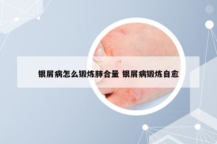 银屑病怎么锻炼肺合量 银屑病锻炼自愈