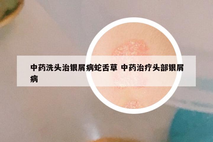 中药洗头治银屑病蛇舌草 中药治疗头部银屑病