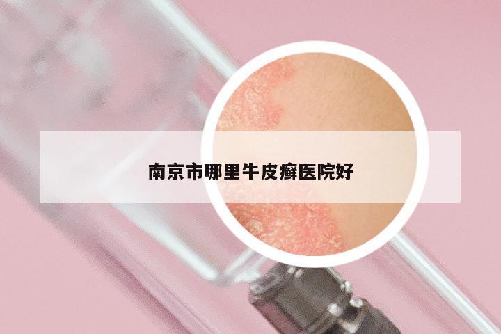 南京市哪里牛皮癣医院好