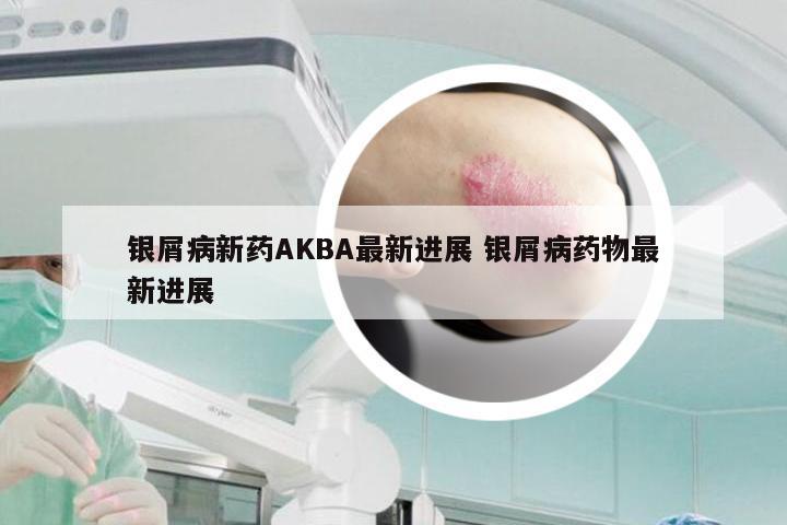 银屑病新药AKBA最新进展 银屑病药物最新进展