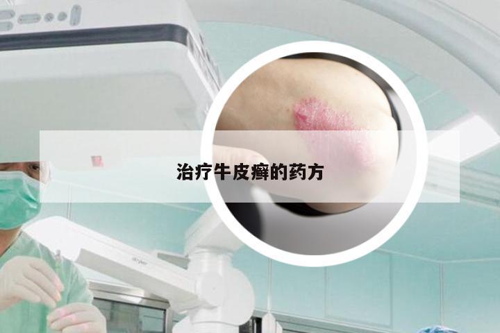 治疗牛皮癣的药方
