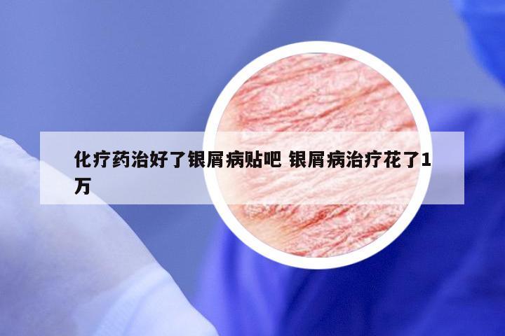 化疗药治好了银屑病贴吧 银屑病治疗花了1万