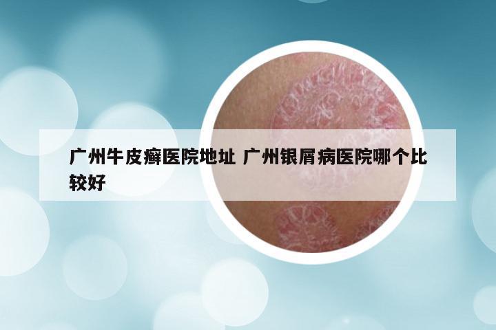 广州牛皮癣医院地址 广州银屑病医院哪个比较好