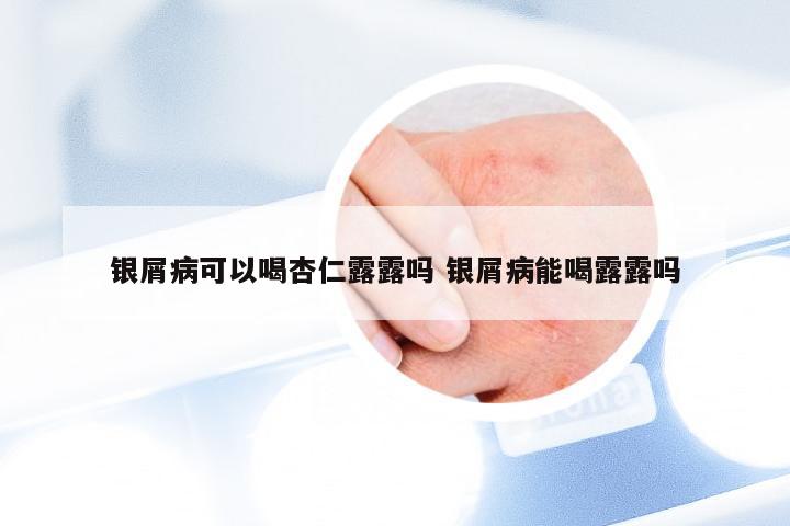 银屑病可以喝杏仁露露吗 银屑病能喝露露吗