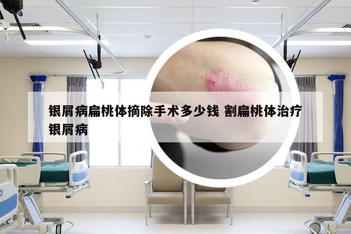 银屑病扁桃体摘除手术多少钱 割扁桃体治疗银屑病