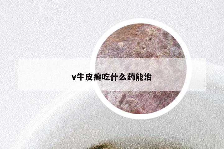 v牛皮癣吃什么药能治