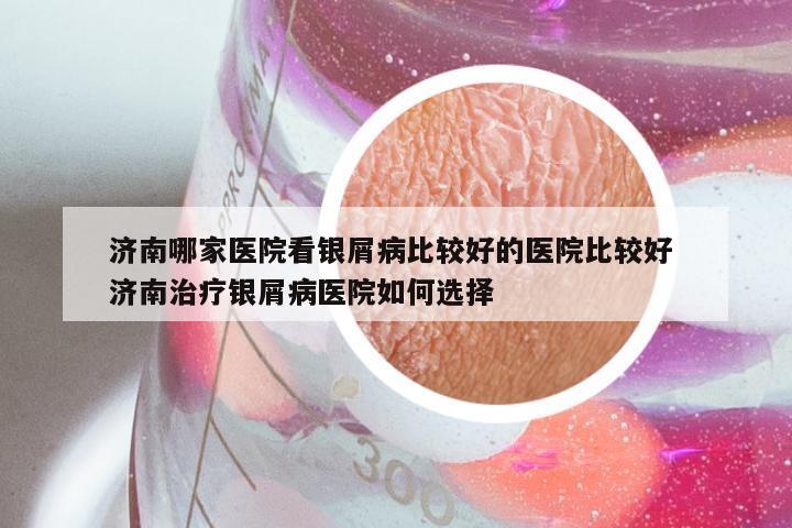 济南哪家医院看银屑病比较好的医院比较好 济南治疗银屑病医院如何选择