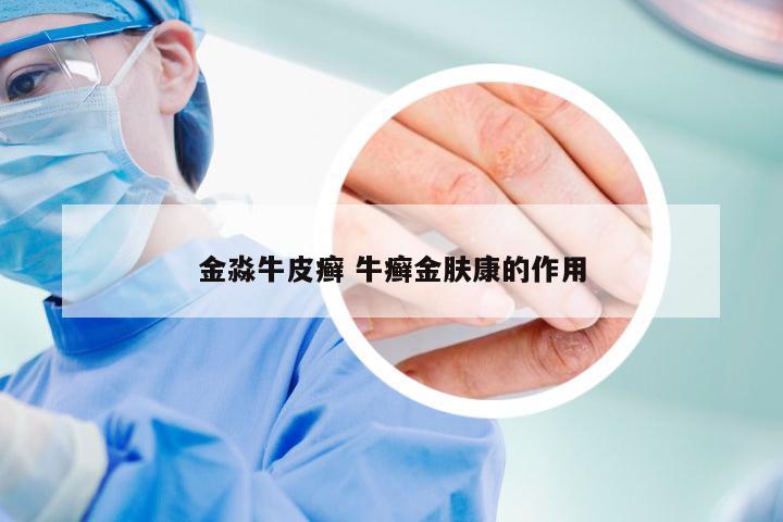 金淼牛皮癣 牛癣金肤康的作用