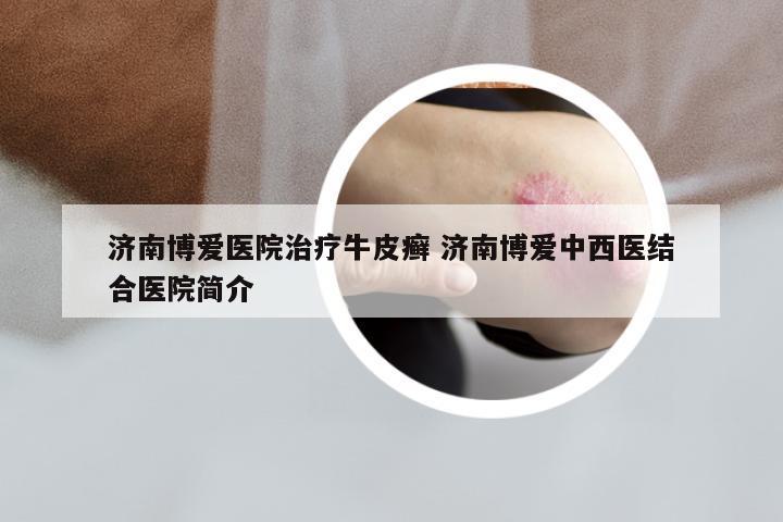 济南博爱医院治疗牛皮癣 济南博爱中西医结合医院简介