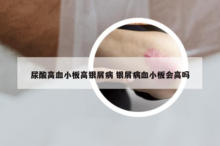 尿酸高血小板高银屑病 银屑病血小板会高吗