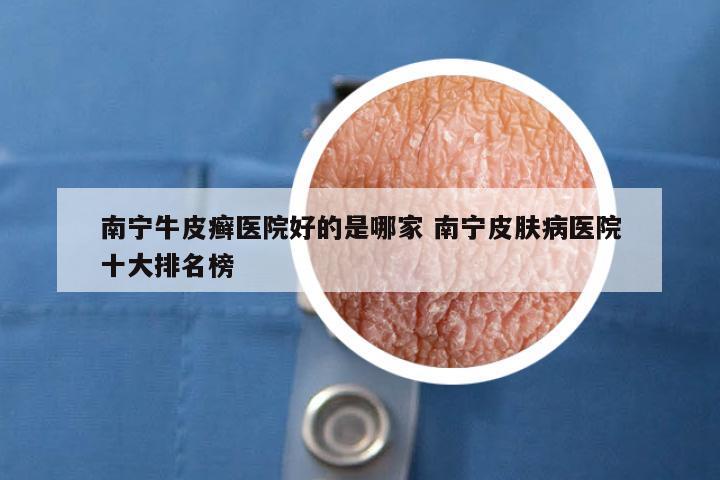 南宁牛皮癣医院好的是哪家 南宁皮肤病医院十大排名榜