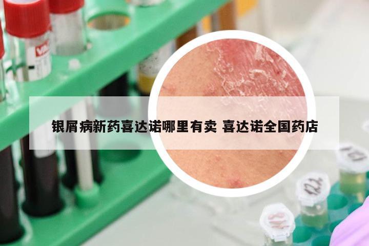 银屑病新药喜达诺哪里有卖 喜达诺全国药店