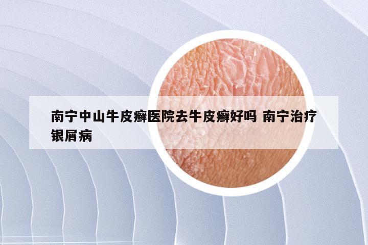 南宁中山牛皮癣医院去牛皮癣好吗 南宁治疗银屑病