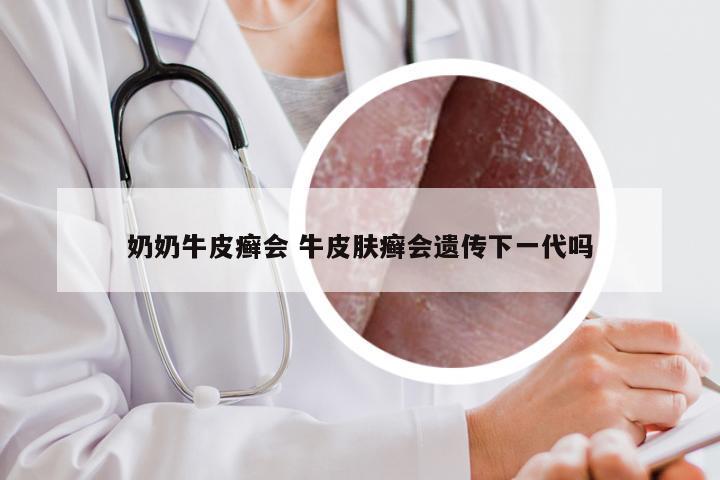 奶奶牛皮癣会 牛皮肤癣会遗传下一代吗