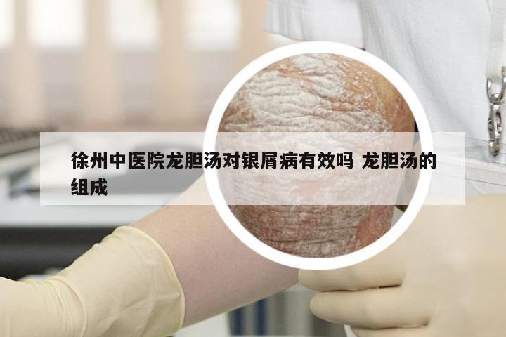 徐州中医院龙胆汤对银屑病有效吗 龙胆汤的组成