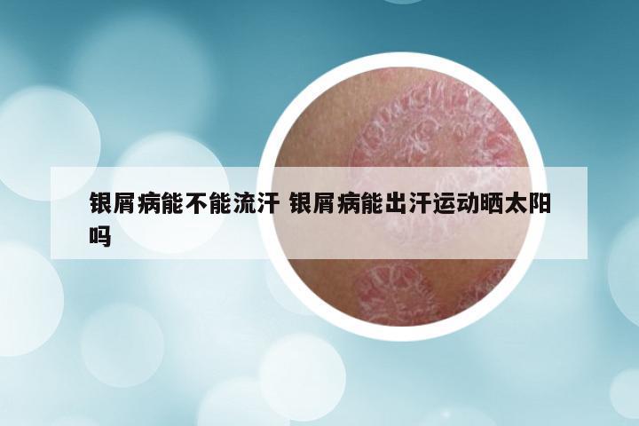 银屑病能不能流汗 银屑病能出汗运动晒太阳吗