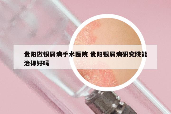 贵阳做银屑病手术医院 贵阳银屑病研究院能治得好吗