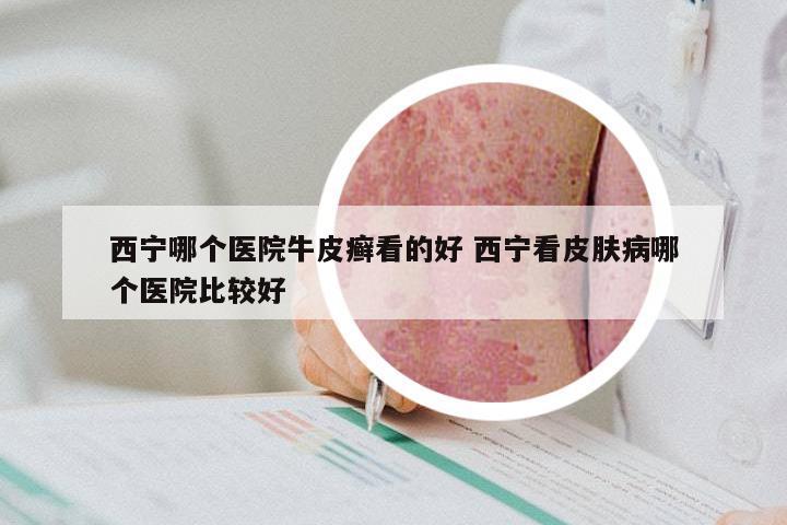 西宁哪个医院牛皮癣看的好 西宁看皮肤病哪个医院比较好