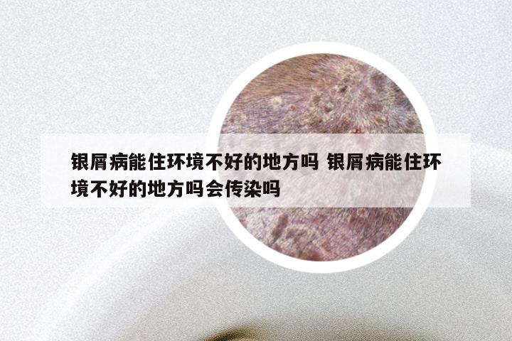 银屑病能住环境不好的地方吗 银屑病能住环境不好的地方吗会传染吗