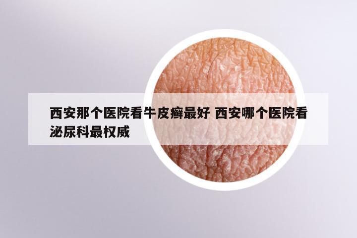 西安那个医院看牛皮癣最好 西安哪个医院看泌尿科最权威