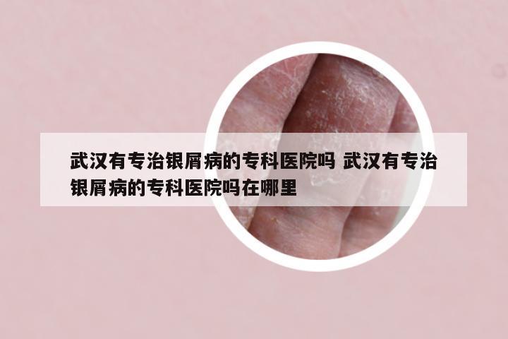 武汉有专治银屑病的专科医院吗 武汉有专治银屑病的专科医院吗在哪里