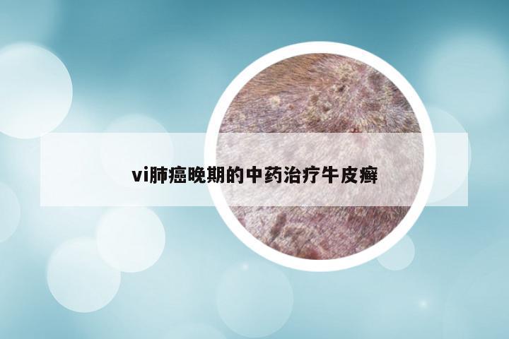 vi肺癌晚期的中药治疗牛皮癣
