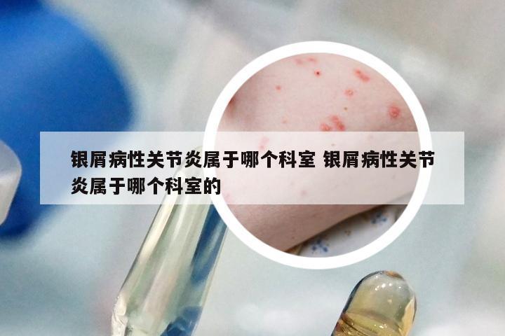 银屑病性关节炎属于哪个科室 银屑病性关节炎属于哪个科室的