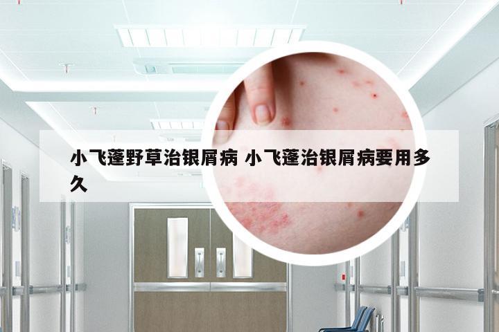 小飞蓬野草治银屑病 小飞蓬治银屑病要用多久