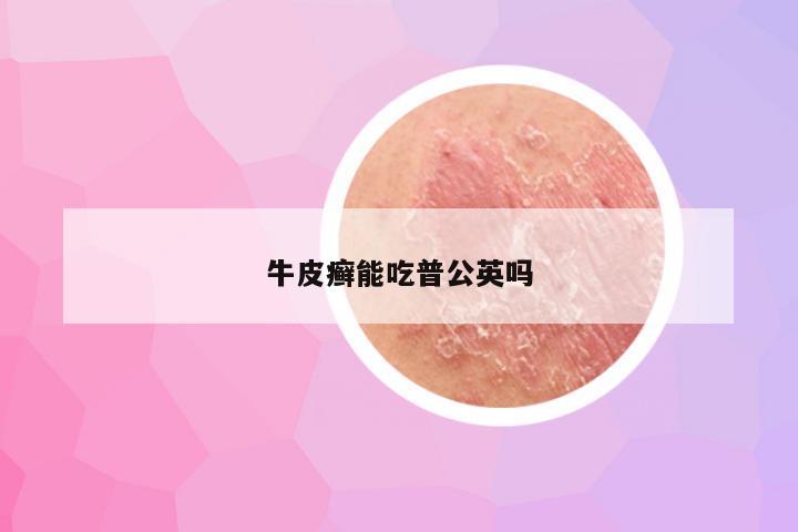 牛皮癣能吃普公英吗