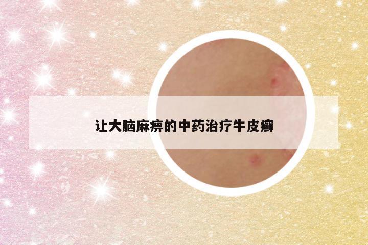让大脑麻痹的中药治疗牛皮癣