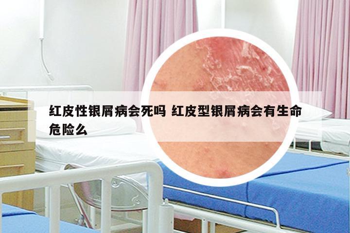 红皮性银屑病会死吗 红皮型银屑病会有生命危险么