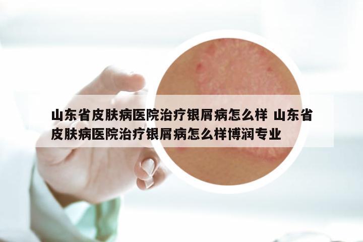山东省皮肤病医院治疗银屑病怎么样 山东省皮肤病医院治疗银屑病怎么样博润专业