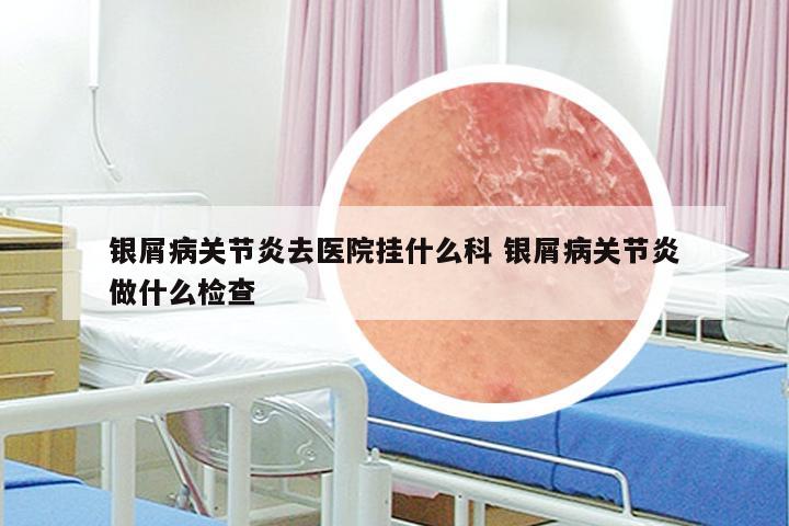 银屑病关节炎去医院挂什么科 银屑病关节炎做什么检查