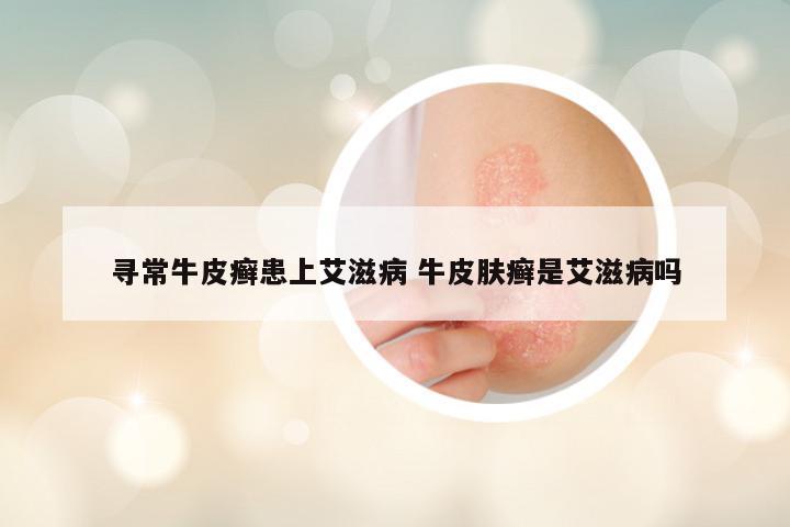 寻常牛皮癣患上艾滋病 牛皮肤癣是艾滋病吗