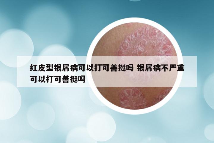 红皮型银屑病可以打可善挺吗 银屑病不严重可以打可善挺吗