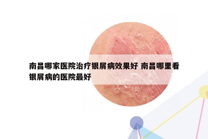 南昌哪家医院治疗银屑病效果好 南昌哪里看银屑病的医院最好