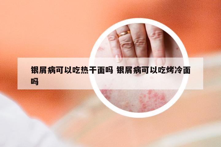 银屑病可以吃热干面吗 银屑病可以吃烤冷面吗