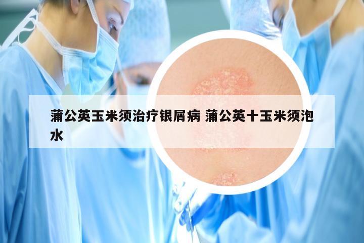 蒲公英玉米须治疗银屑病 蒲公英十玉米须泡水