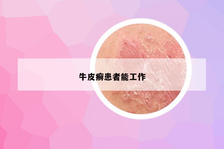 牛皮癣患者能工作