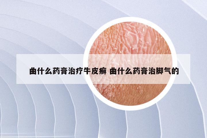 曲什么药膏治疗牛皮癣 曲什么药膏治脚气的